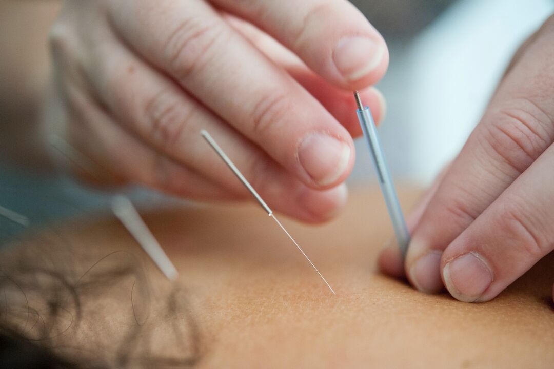A acupuntura é uma maneira ineficaz de parar de fumar
